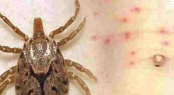 scrub typhus | ದೇಶದಲ್ಲೀಗ ಕೊರೋನಾ ನಂತರ “ಸ್ಕ್ರಬ್ ಟೈಫಸ್” ತಲೆಬಿಸಿ..! |