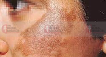 #Melasma | ಚೆಲುವಿಗೆ ಕುಂದು ತಂದಿದೆಯೇ ಬಂಗು | ಇದಕ್ಕೆ ಆಯುರ್ವೇದದಲ್ಲಿದೆ ಪರಿಹಾರ |