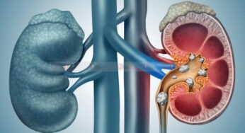 #KidneyStones| ಮೂತ್ರಪಿಂಡದ ಕಲ್ಲುಗಳ ಸಮಸ್ಯೆ| ಆಯುರ್ವೇದದಲ್ಲಿದೆ ಸುಲಭ ಪರಿಹಾರ